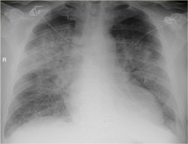 Chest radiograph showing lung opacities
